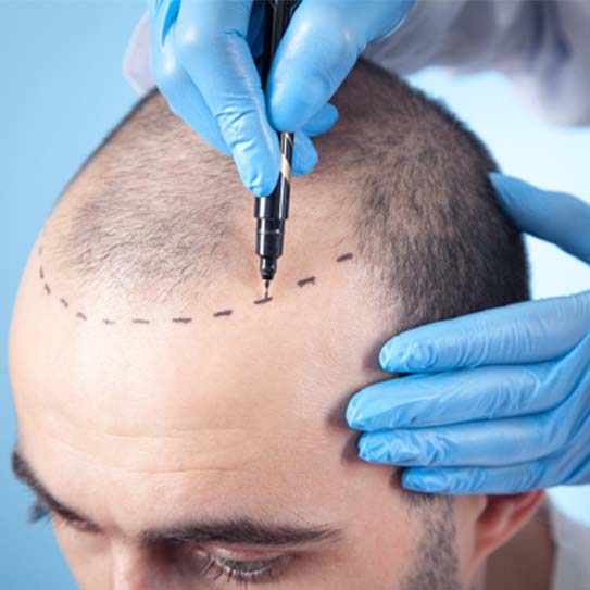 know-more-about-Hair Transplant-treatment-in-Patna